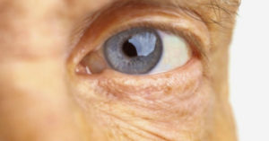 DEGENERACION_MACULAR_RELACIONADA_CON_LA_EDAD