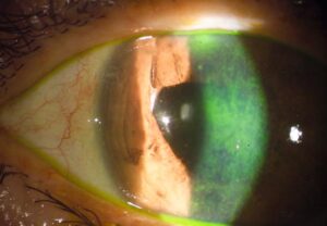 cataratas y ojo seco