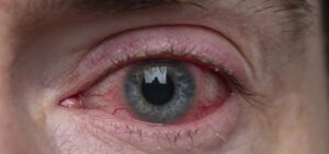 conjuntivitis
