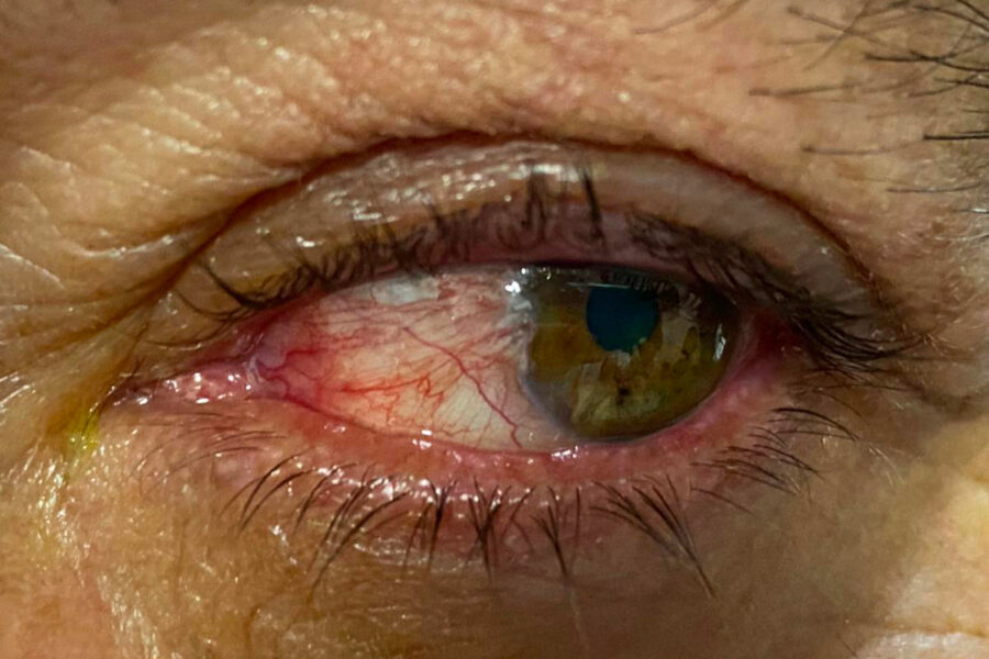 El Papel de la Farmacología en el Éxito de la Cirugía de Pterigión: Guía de Manejo Terapéutico
