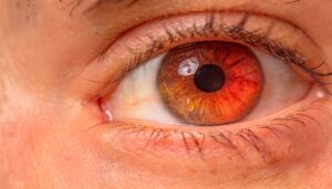 tratamiento-sindrome-de-ojo-seco