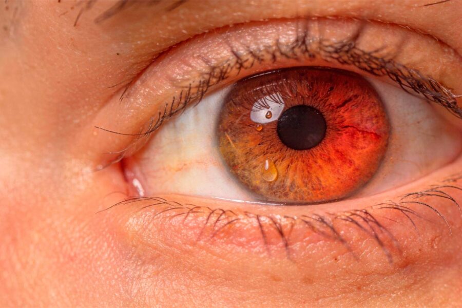 tratamiento-sindrome-de-ojo-seco